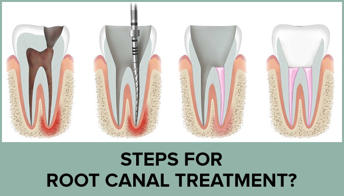 Root canal treatment at Comfort Dental