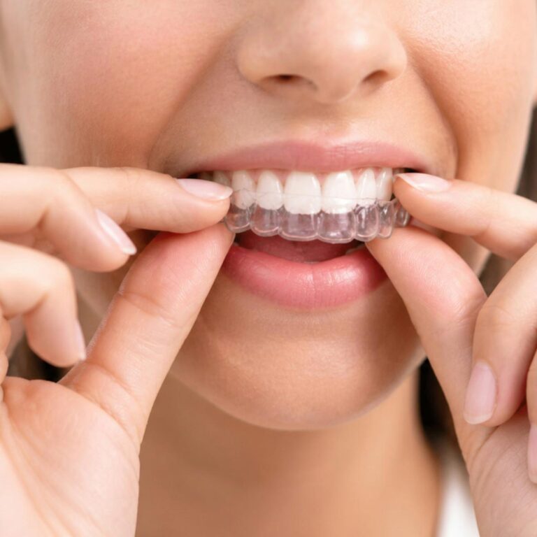 Can You Straighten Your Teeth Without Traditional Braces?